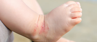 Baby with atopic dermatitis