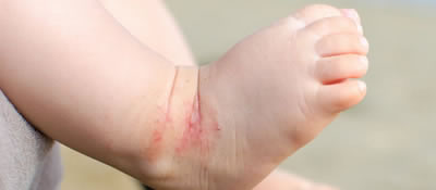 ASCIA Paediatric atopic dermatitis (eczema) e-training for health professionals